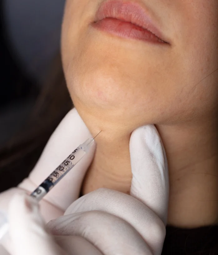 Kybella The Sculptry Lake Charles